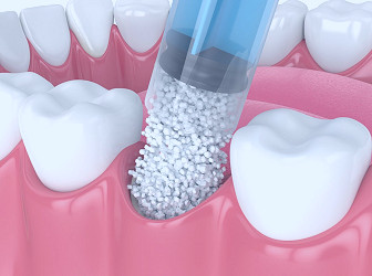 Dental Bone Graft - Bone Graft for Dental Implant